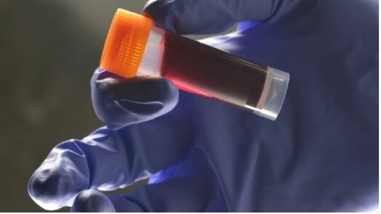 تشخیص بروز سکته زودهنگام به کمک گروه خونی