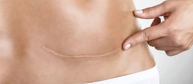 Complications of remaining sutures in the abdomen