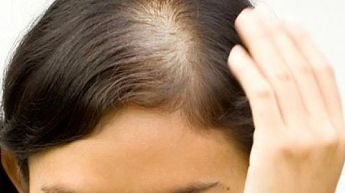 Can hormonal hair loss be treated?
