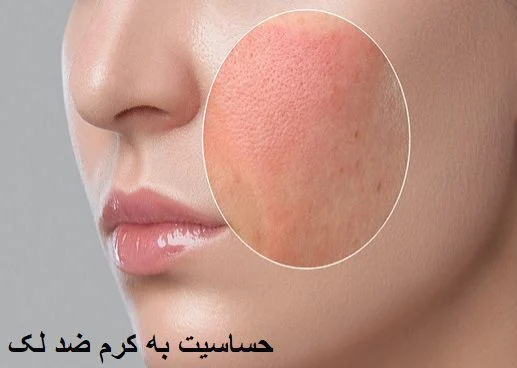 &nbsp;حساسیت پوستی و درمان با کرم های خاص