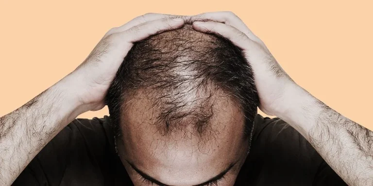 ریزش مو _ بهترین روش های تخصصی و خانگی