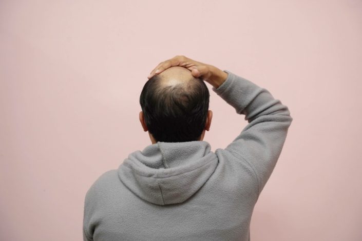 رشد چشمگیر مو با کلاسکوترون: امیدی تازه برای طاسی مردانه