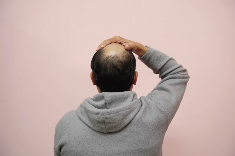 رشد چشمگیر مو با کلاسکوترون: امیدی تازه برای طاسی مردانه